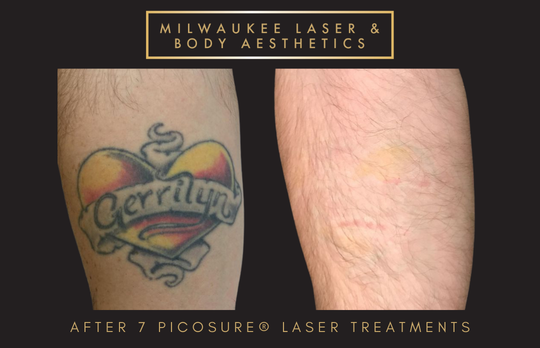 Tattoo Removal - 7 Treatments before and after image