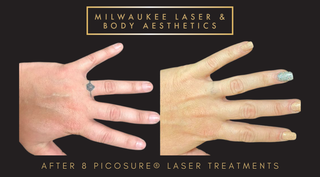 Tattoo Removal - 8 Treatments before and after image