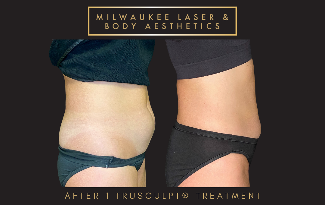 Body Sculpting - 1 Treatment before and after image