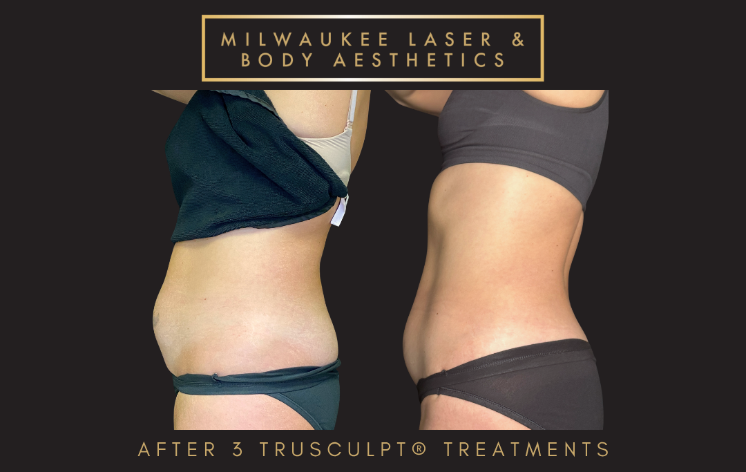 Body Sculpting - 3 Treatments before and after image