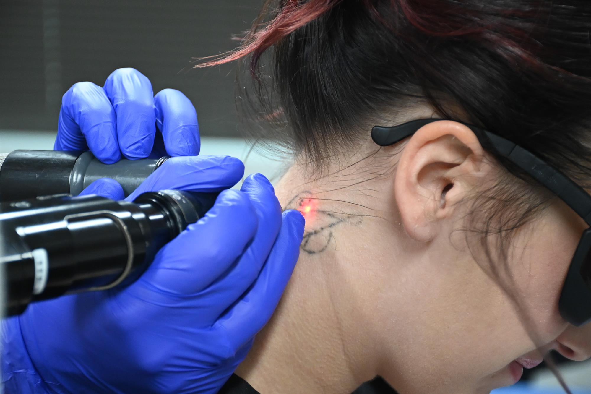 How to decided if tattoo removal is right for you