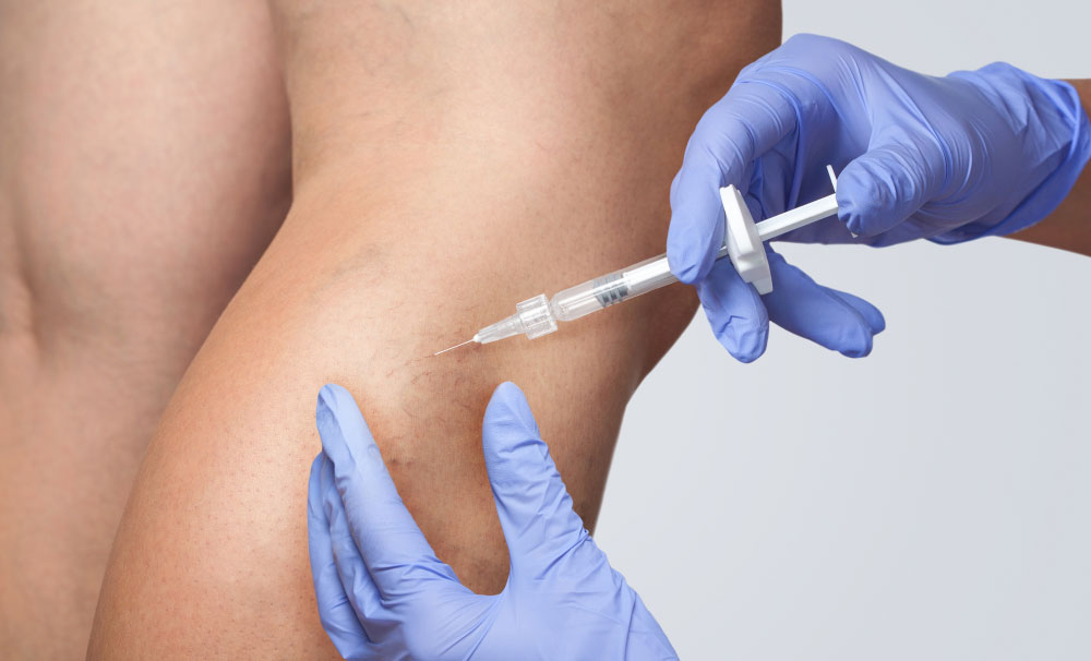 What Are Spider Veins and Why Do They Appear?