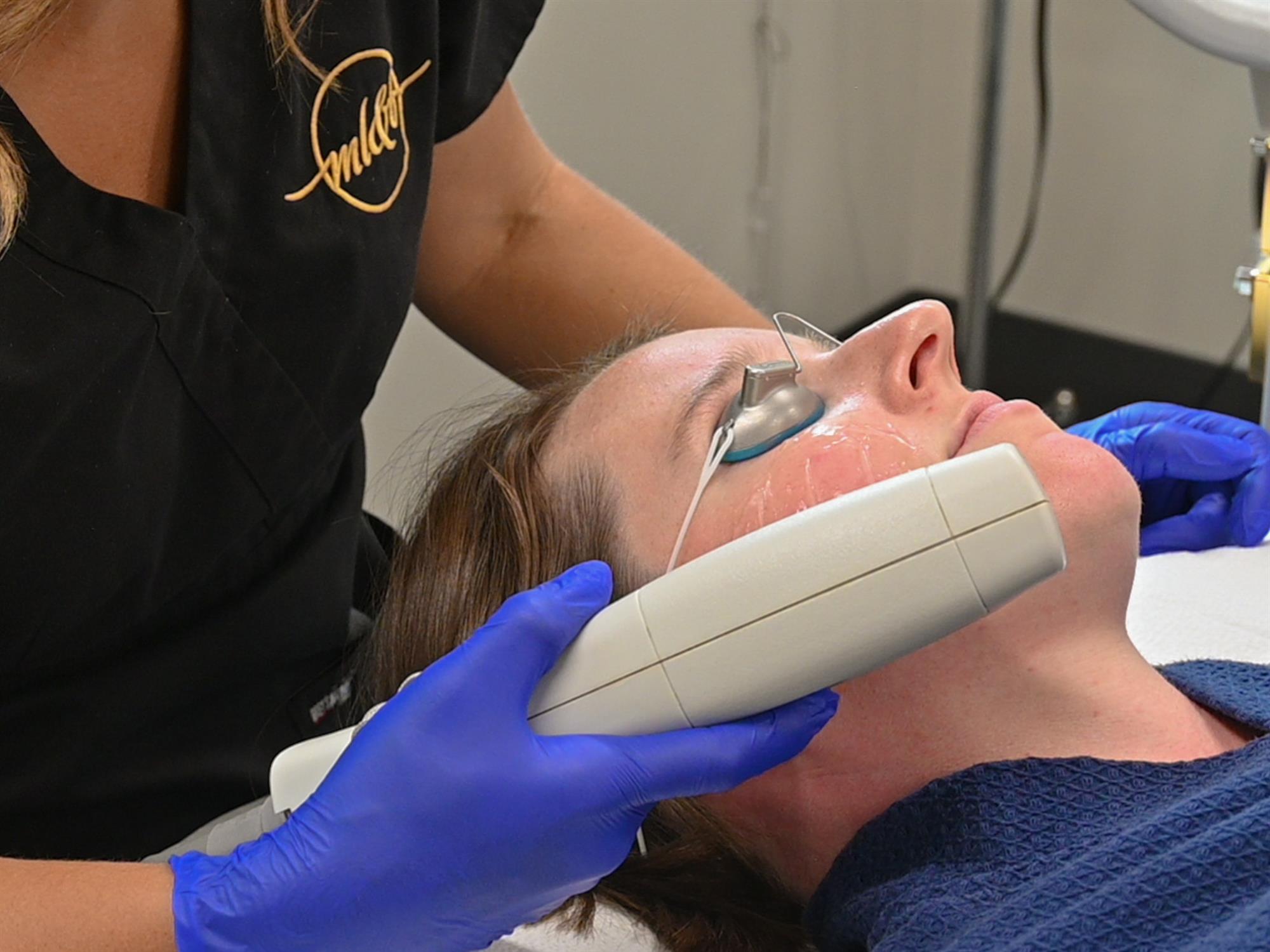 sun spot treatment in Milwaukee