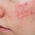 Rosacea, Red Spots & Cherry Angioma