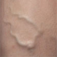 Varicose vein treatment