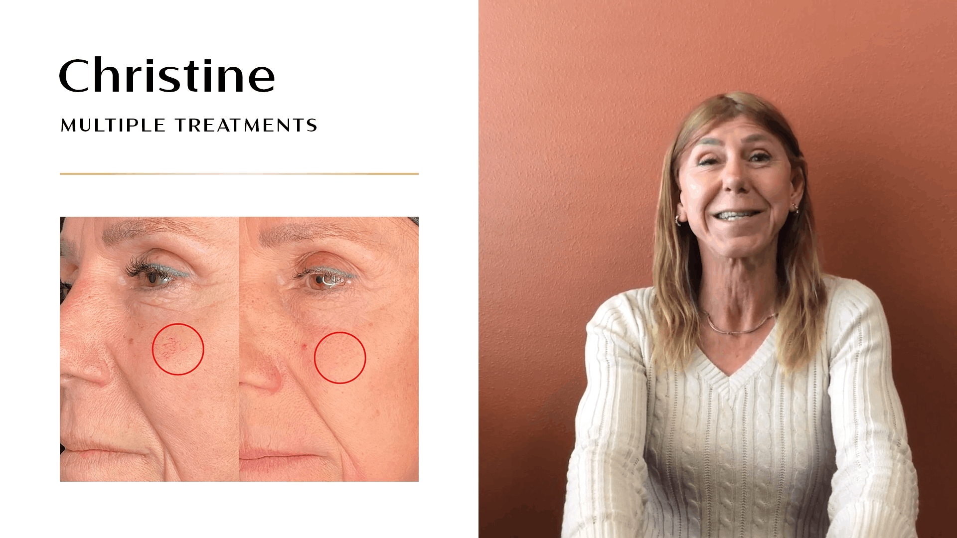 Confidence Restored: Christine's Path to Glowing Skin